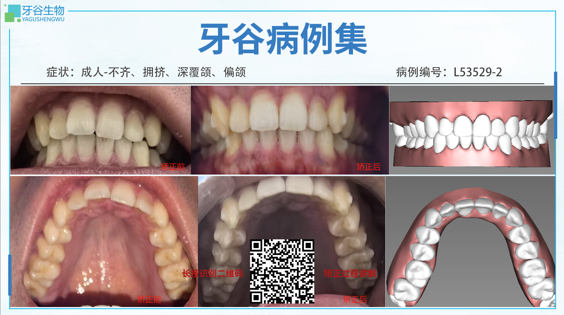 L53529-2，Irregular dentition，Crowded teeth，Deep overbite 2024/3/12-2024/11/14 