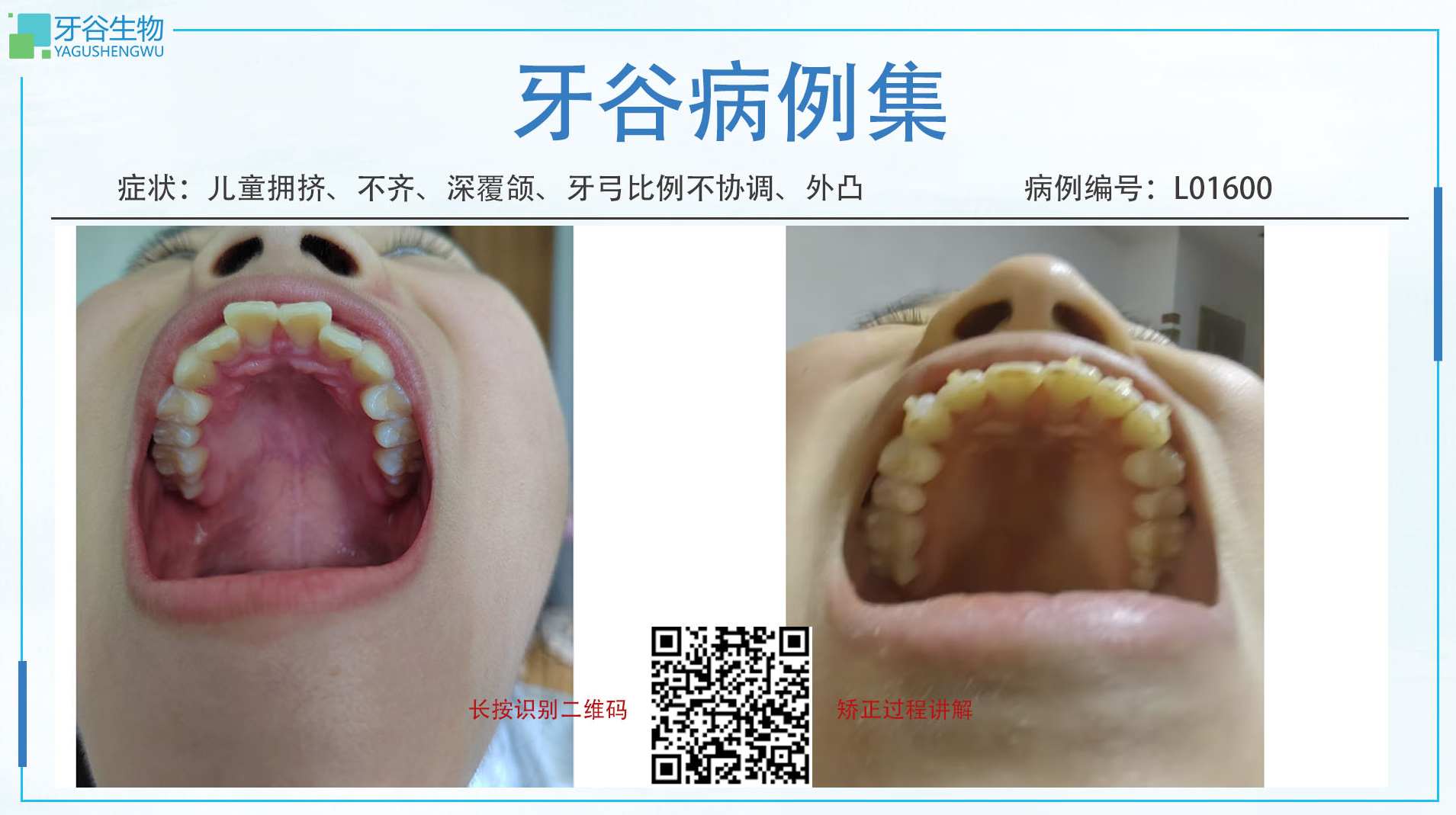 Irregular dentition，Crowded teeth，Deep overbite，Interarch tooth size disc	2024/8/18-2025/3/12