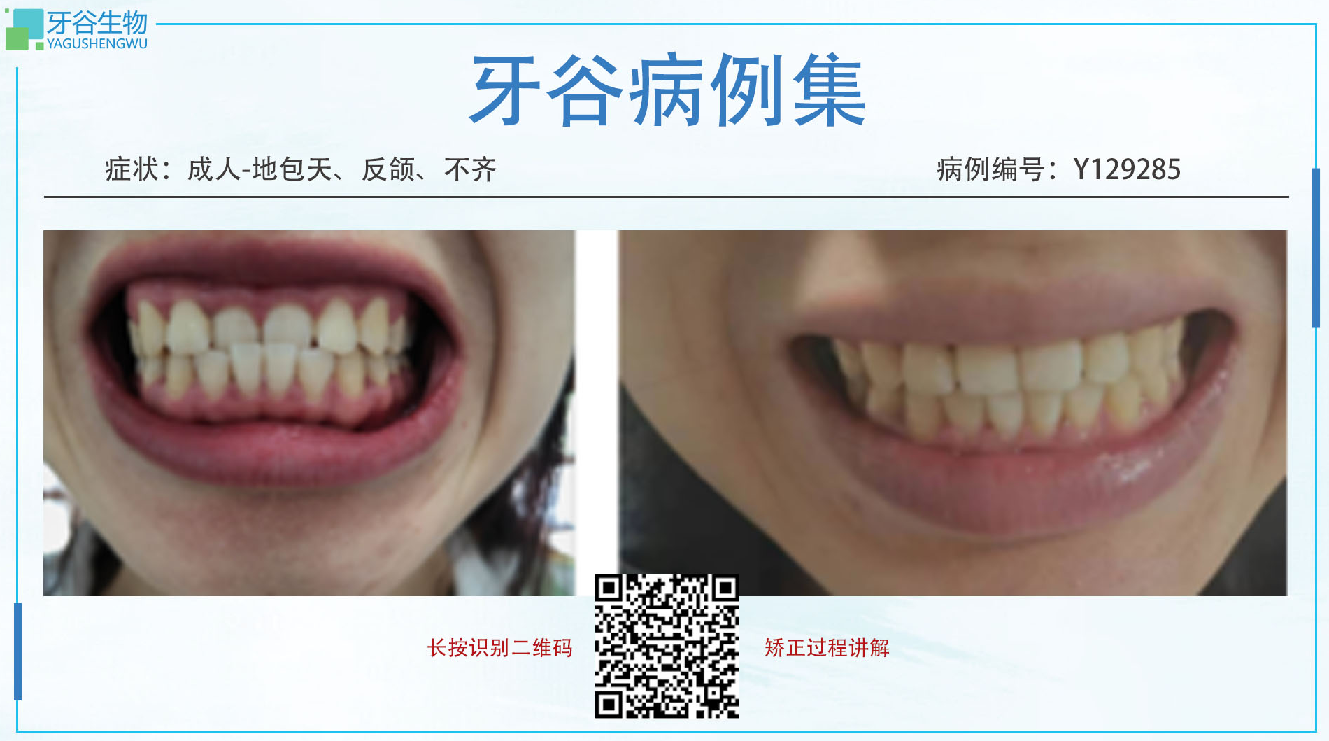 Y129285,Underbite，Irregular dentition，Anterior crossbite	2024/8/7 -2025/2/19 